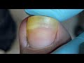 Satisfying Toenail repair