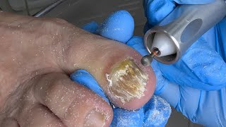 Extreme Fungal Nail Removal – Watch at Your Own Risk!