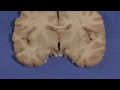 hypothalamus neuroanatomy video lab brain dissections