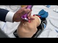 bebe Vie (tm) by Adroit Surgical Intro  and demo of how to use Oct 2022