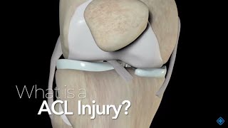 ACL Injury: Q\u0026A