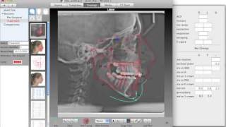 Quick Ceph Studio - Treatment Planning and Morphing