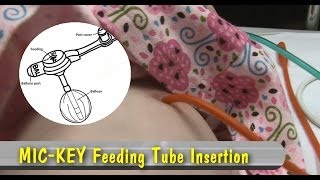 MIC-KEY Feeding Tube Insertion