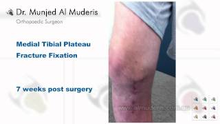 Medial Tibial Plateau Fracture Fixation - 7 weeks post surgery