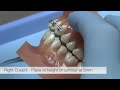 american orthodontics alexander lts brackets bracket placement video