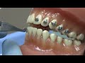 american orthodontics alexander lts brackets bracket placement video