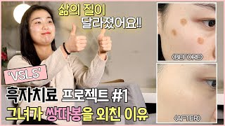 VSLS! 검버섯(흑자) 1번 시술로 2주만에 완전 제거!