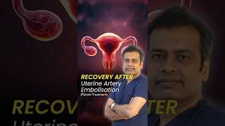 Recovery after Uterine Artery Embolisation | Recovery Time after Uterine Fibroid Embolization (UFE)