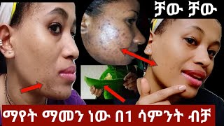 ማየት ማመን ነው በ1 ሳምንት ብቻ ቻው ቻው ለቡግር ለጥቋቁር ነጠብጣብ ለፊት ጥራት ዋው  how to get rid of pimples overnight