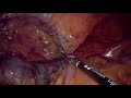 Laparoscopic Right Colectomy with CME: Three-trocars Technique