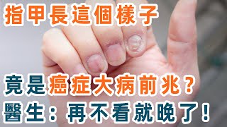 指甲出現這4個變化，竟是癌症和大病的前兆？醫生終於給出了答案，讓人嚇一跳！建議你再忙都花2分鐘看看【養生1+1】