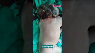 बिना ब्रेन का बेबी | Baby without brain | Anencephaly | Neural tube defect | Dr MD Noor Alam Khan