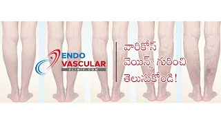 వారికోస్ వెయిన్స్ గురించి తెలుసుకోండి!# Dr Rajesh Poosarla# Varicose veins# Telugu # laser treatment