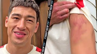DMITRY BIVOL MORNING AFTER CANELO FIGHT SHOWS BRUISED ARM; SAYS HE WANTS 168 UNDISPUTED TITLES