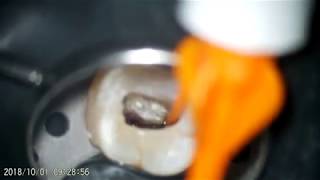 retreatment of an upper molar with fused DB and P roots