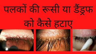 पलकों और ब्रो की रूसी को कैसे हटाए | How To Get Rid Of Dandruff On Eyelashes \u0026 Eyebrows