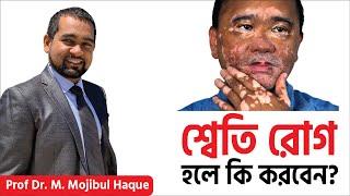 শ্বেতী রোগ (vitiligo) এর সঠিক চিকিৎসা পদ্ধতি। ACRH | Dr Haque