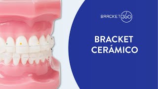 Bracket Cerámico🦷🎇La opción estética más económica