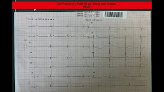 What Should We Do in Chest Pain and Severe Bradycardia Patient? Should We Give Sulfas Atropin?