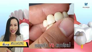 ครอบฟันเซรามิก ที่ Hollywood Smile Clinic #ครอบฟัน #แบบใหม่ #review