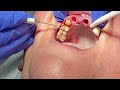 immediately extraction and immediate denture