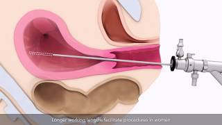 Basics of hysteroscopy | TVASurg