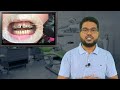 দাঁতে ব্রেস পড়ানোর খরচ কত টাকা orthodontics braces treatment cost dental brace.by smile bd.