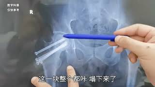 外伤导致骨折，手术做得很好，为什么却出现继发性的股骨头坏死？