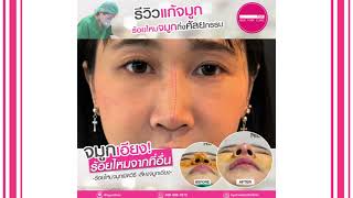 ร้อยไหมจมูกที่อื่นแล้วพังมาแก้ใหม่กับคุณหมอจิ๋ง NYC CLINIC