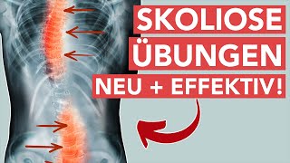 Skoliose übungen - Neue effektive Behandlungsmethode