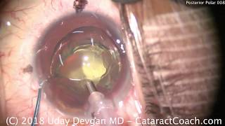 Successful Posterior Polar Cataract Surgery Technique