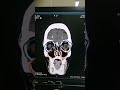 Farhr Syndrome | Syndrome of Head | Calcific densities seen on CT | Dr Green Side | Medical Imaging