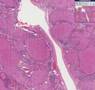 Histopathology Liver--Cirrhosis