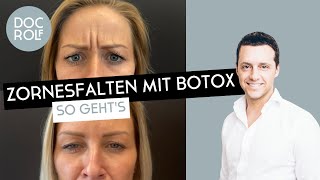 ZORNESFALTE mit BOTOX behandeln – darauf muss man achten!! Dr Rolf Bartsch