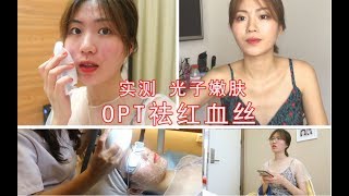 医美初尝试！光子嫩肤对敏感皮红血丝真的有效吗？opt祛红实测！