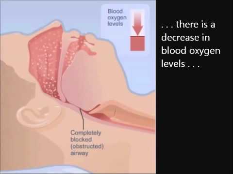 How CPAP works 5_23_11.wmv How CPAP works 5_23_11.wmv