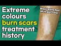 Black, White, Red Extreme colours burn scars treatment history