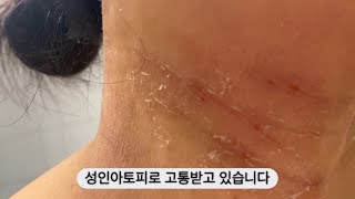 아토피 브이로그 (1) 아토피를 이겨내는 3가지 방법