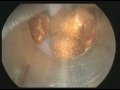 Large bladder stone 2 procedure SIU 2009 office urology instructional course