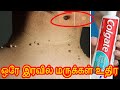 ஒரே இரவில் மருக்கள் உதிர | maru poga tips in tamil | Skin tag | marukkal uthira | #maru #skintag