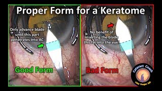 proper form for keratome use during cataract surgery for creating the phaco incision