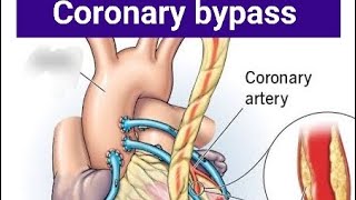 coronary artery bypass animated