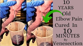 ELBOW PAIN TREATMENT BY VENESECTION (FASD) @HIJAMA TUTORIAL, GAYA