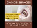 damon braces all you need to know about