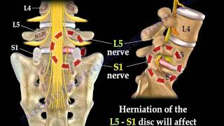 Low Back Pain -   Disc  Herniation ,Sciatica  - Everything You Need To Know - Dr. Nabil Ebraheim
