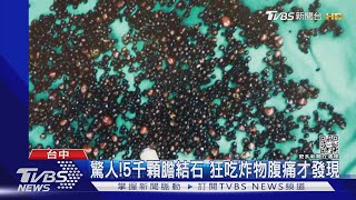 驚人!5千顆膽結石 狂吃炸物腹痛才發現｜TVBS新聞