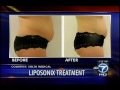 dc derm docs liposonix abc 7