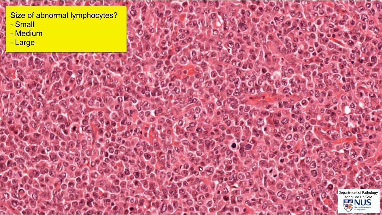 Lymph Node Large Cell Lymphoma Microscopy Talking Slide Youtube