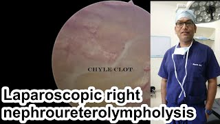 Milky urine|Chyluria|Laparoscopic right lympholysis|Dr Brojen Barman