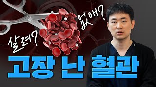 하지정맥류 고장 난 혈관, 없애도 혈액 순환이 될까?